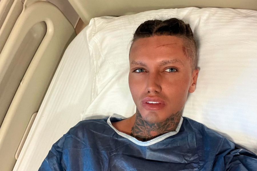 IMAO JE PET PLASTIČNIH OPERACIJA NA LICU U ISTO VREME: "Hteo sam da izgledam kao Barbi, a dobio sam izgled Šreka!" (VIDEO)