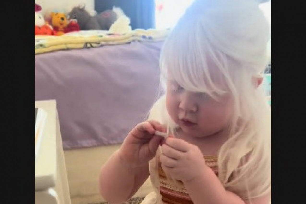 OVA PRESLATKA DEVOJČICA IMA REDAK GENETSKI POREMEĆAJ: Ne igra se napolju, običan sunčan dan za nju može biti poguban(FOTO)