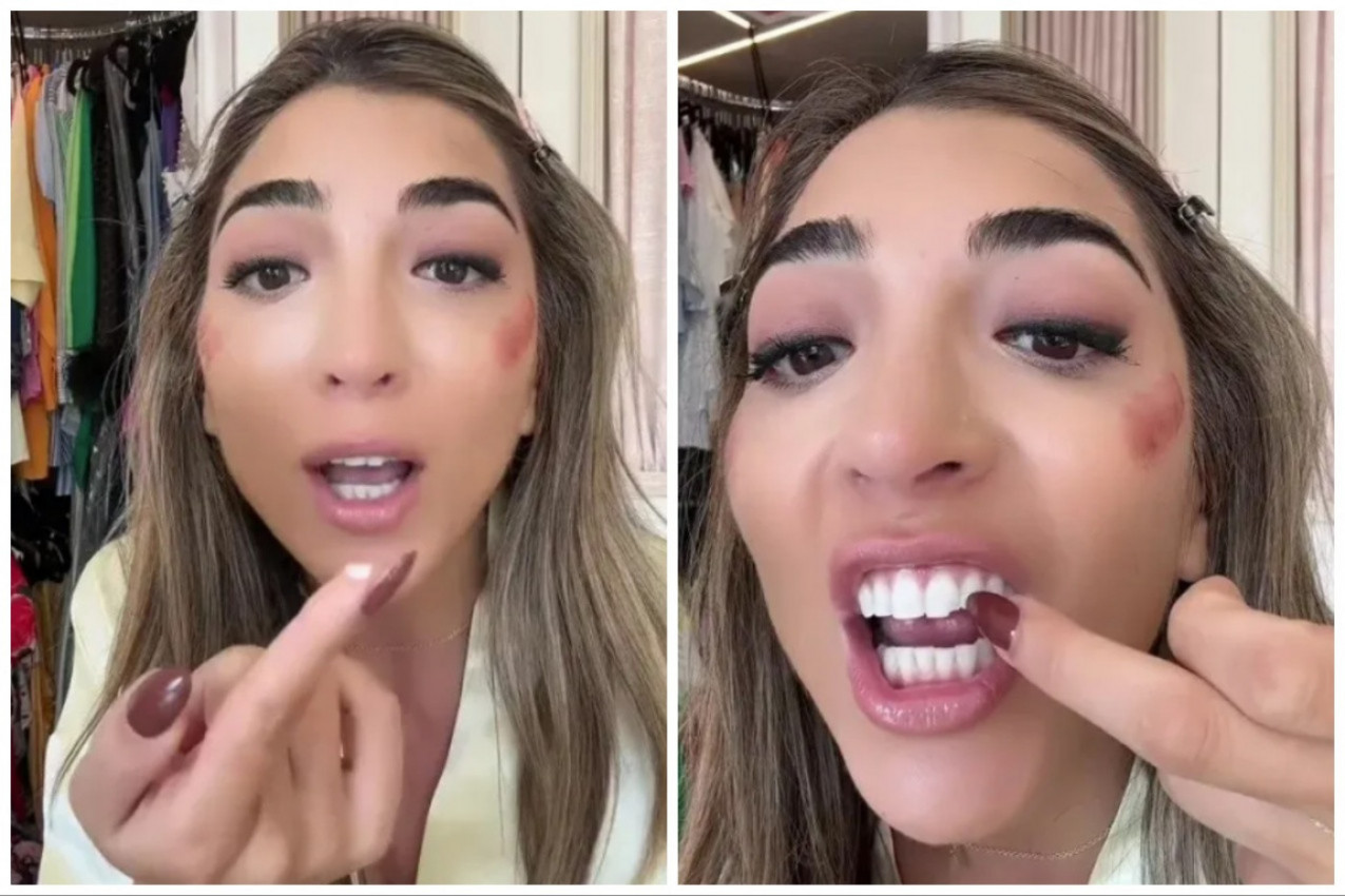 ZUB JOJ JE ISPAO DOK SE ŠMINKALA ZA ŽURKU, NIJE IMALA VREMENA PA GA JE ZALEPILA SUPERLEPKOM: Mislila je kako joj je trik uspešan, a onda je otišla kod zubara i tek je usledila drama (VIDEO)