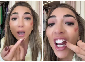 ZUB JOJ JE ISPAO DOK SE ŠMINKALA ZA ŽURKU, NIJE IMALA VREMENA PA GA JE ZALEPILA SUPERLEPKOM: Mislila je kako joj je trik uspešan, a onda je otišla kod zubara i tek je usledila drama (VIDEO)