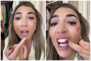 ZUB JOJ JE ISPAO DOK SE ŠMINKALA ZA ŽURKU, NIJE IMALA VREMENA PA GA JE ZALEPILA SUPERLEPKOM: Mislila je kako joj je trik uspešan, a onda je otišla kod zubara i tek je usledila drama (VIDEO)