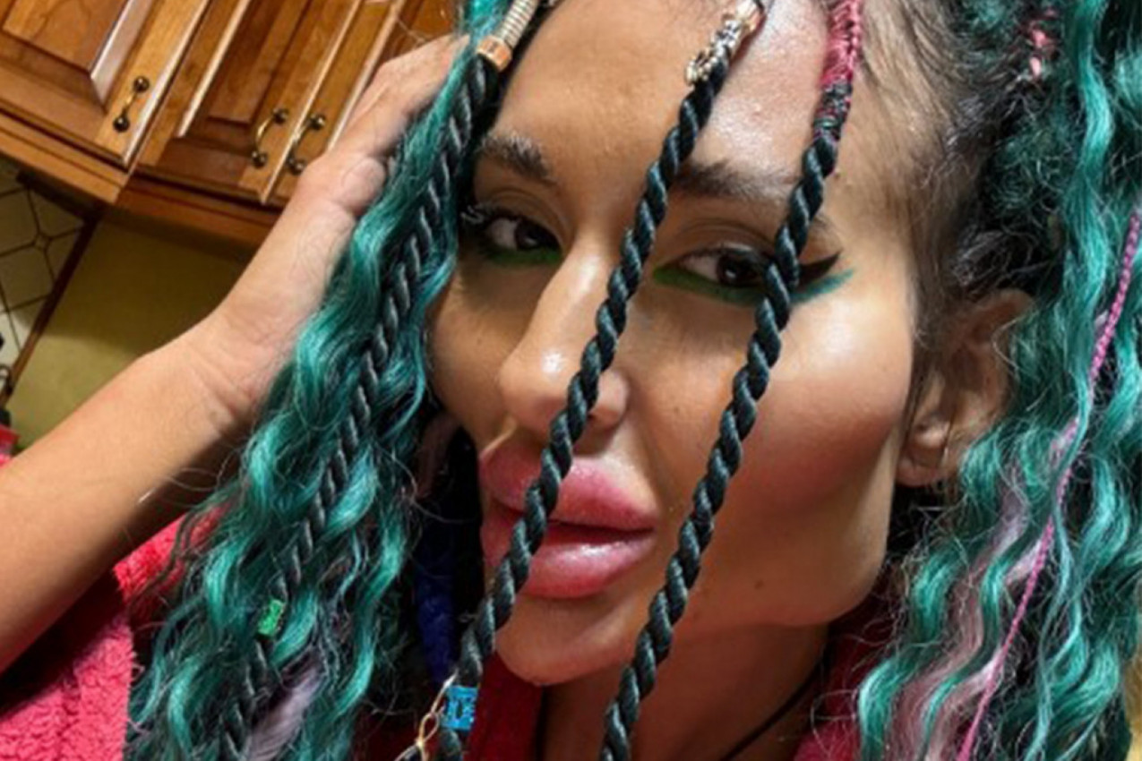 ŽENA SA NAJVEĆIM JAGODICAMA POKAZALA ZASTRAŠUJUĆE REZULTATE NOVE PROCEDURE: Ljudi u neverici gledaju snimak i pitaju je samo jedno (VIDEO)