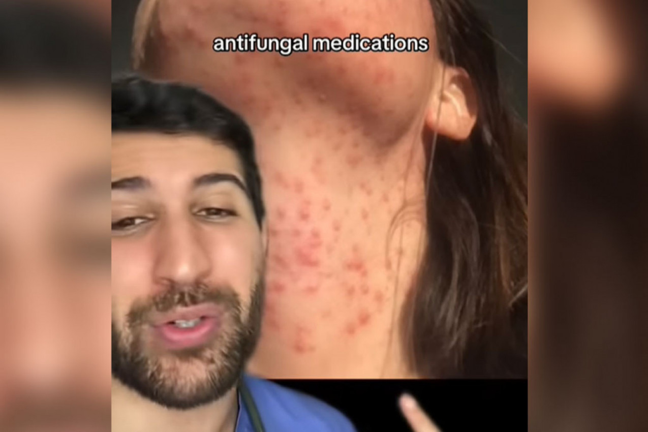 DOKTOR JE POKAZAO SNIMAK UNIŠTENOG LICA MLADE DEVOJKE: Kad čujete šta je uzrok ovog osipa, šokiraćete se (VIDEO)