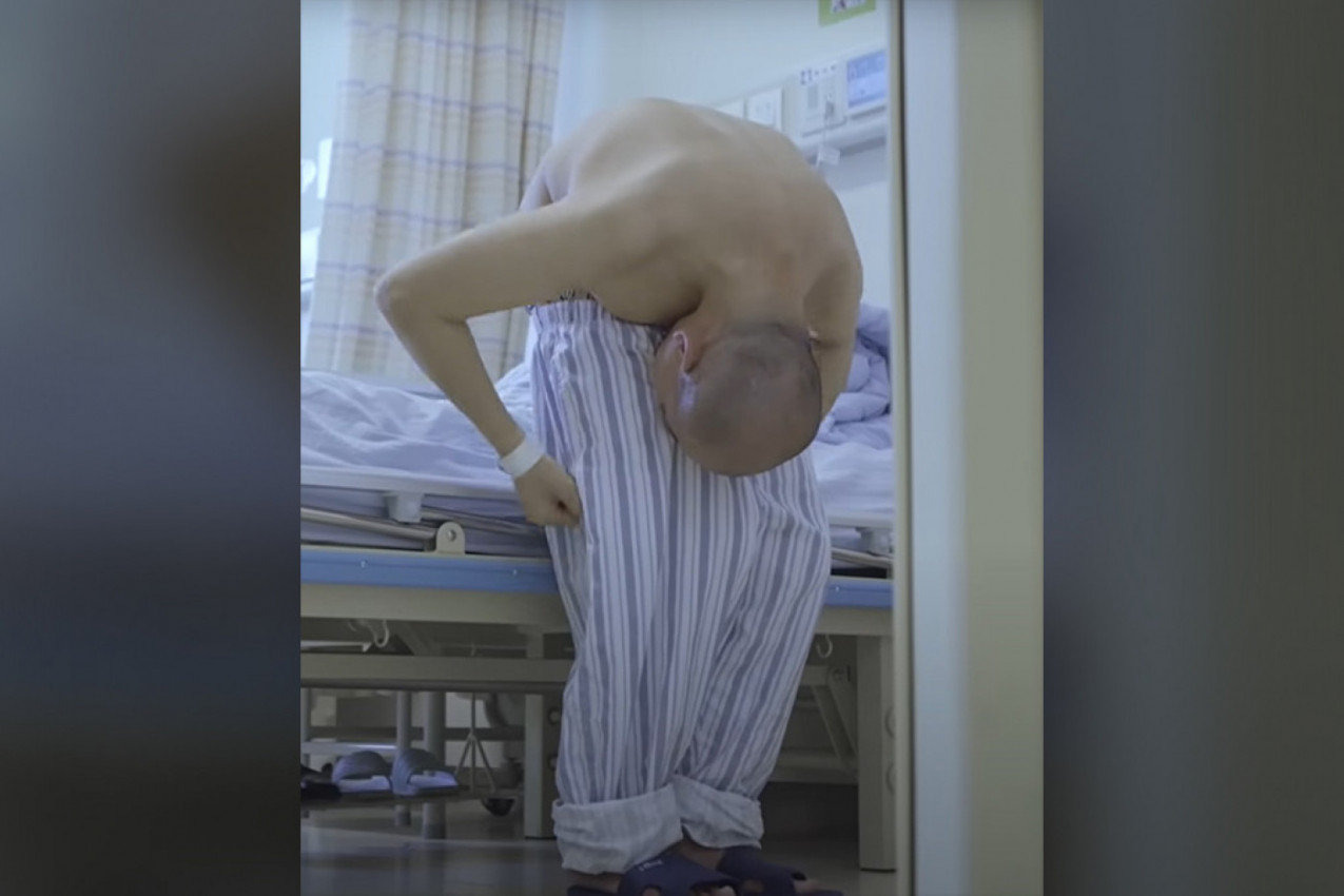 ŽIVEO JE GLEDAJUĆI U SOPSTVENO MEĐUNOŽJE: Za "presavijenog čoveka" se posle dve decenije desilo čudo!(VIDEO)