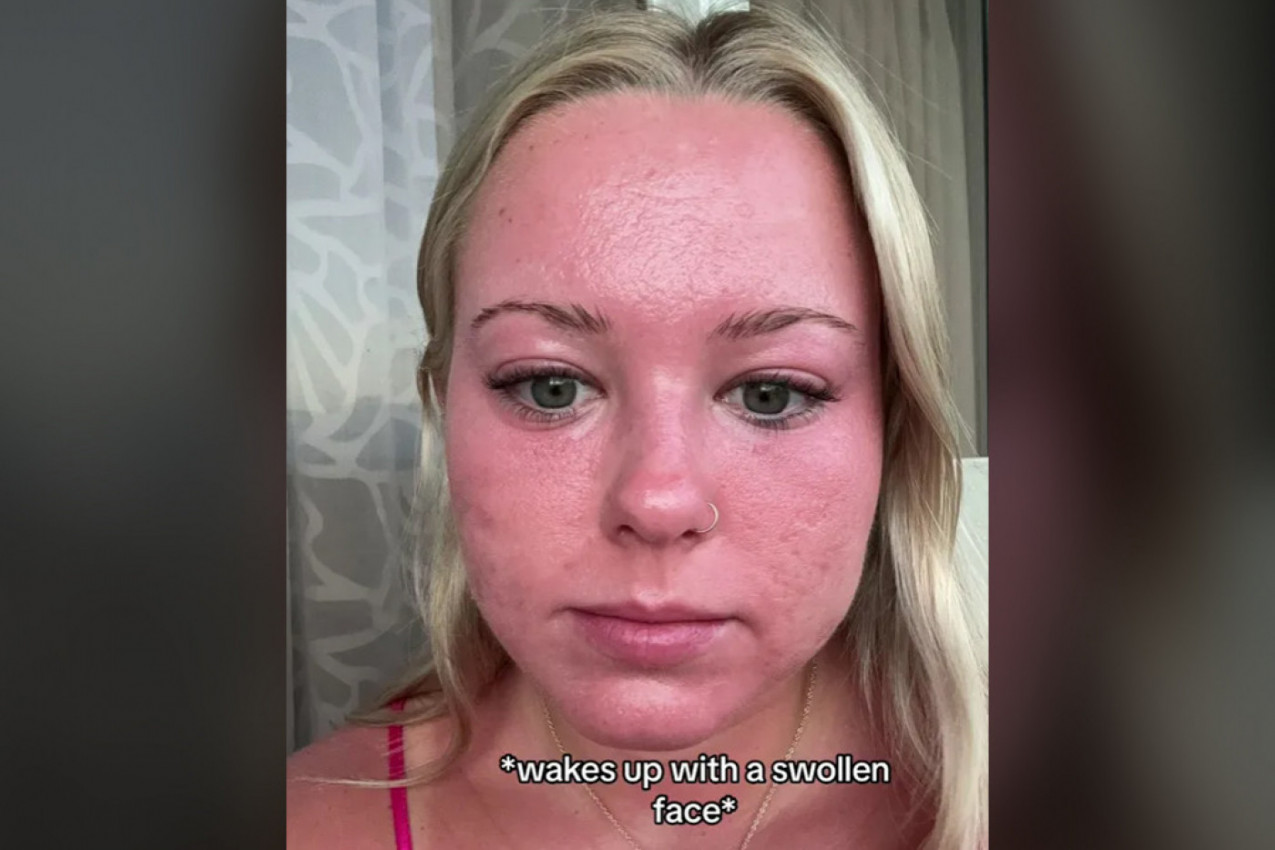 IŠLA SAM U SOLARIJUM PRED LETOVANJE I SAD SAM U AGONIJI: Spaljena joj je koža zbog ove greške, a zbog plikova ne sme da radi ovo (FOTO)