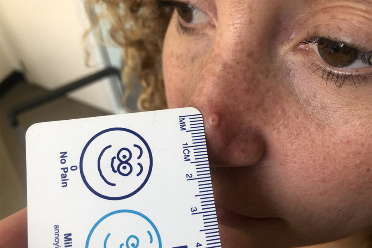 U 8. MESECU TRUDNOĆE MI JE IZAŠLA BUBULJICA NA NOSU: Mislila sam da nije ništa, a ispostavilo se da je opasan rak!