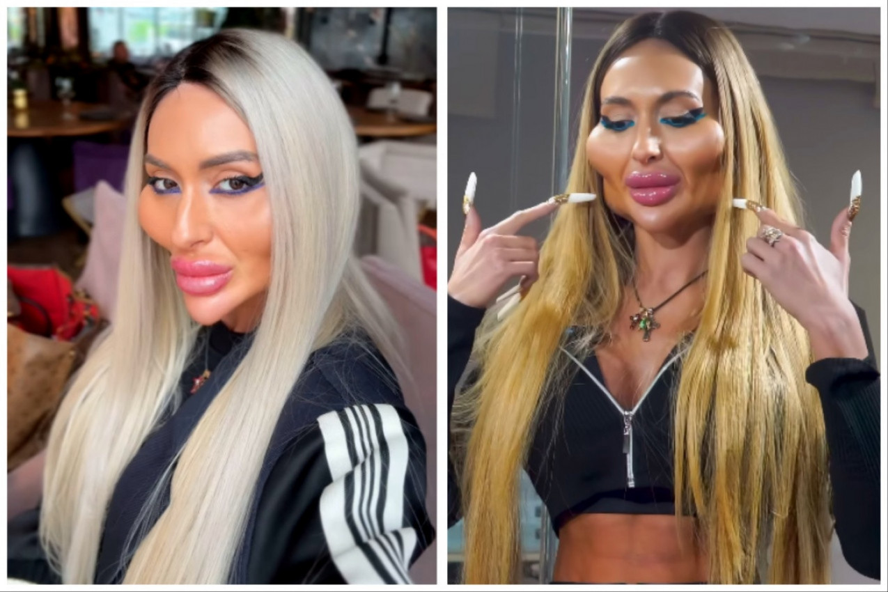 ANASTASIJA JE "HODAJUĆA PLASTIKA": Evo kako je izgledala pre operacija, ljudi se pitaju - što je to sebi uradila?