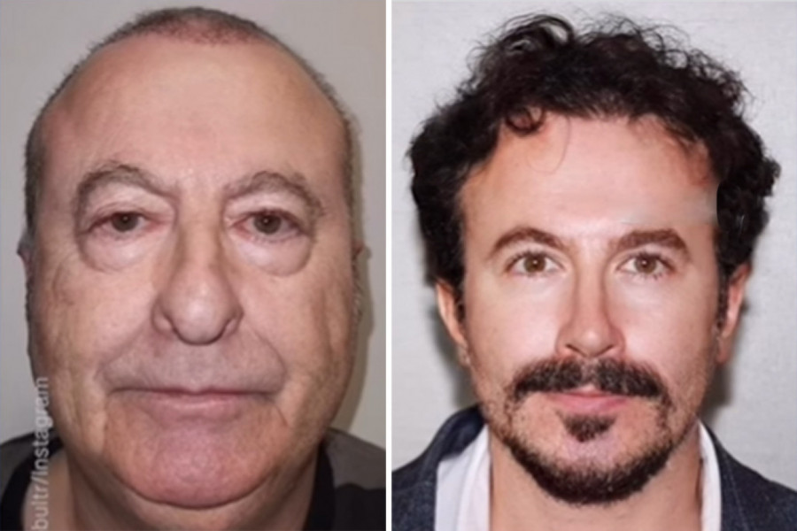 HVALA PLASTIČARU NA TRANSFORMACIJI: Bio kao deda, pa uradio 6 velikih operacija na licu - sad je frajer i po!