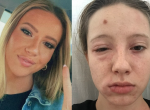 POJELA SAM ČIPS, RUKE SU MI BILE KAO BALON, A OČI OTEČENE: Zbog jednog sastojka zamalo je izgubila život!