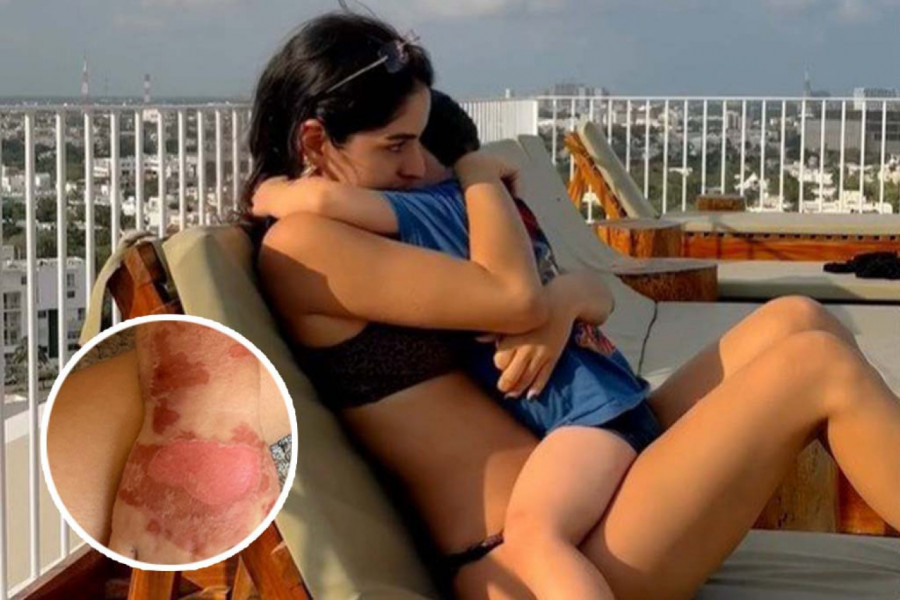 MAJA JE SINA ODVELA KOD LEKARA MISLEĆI DA IMA OPEKOTINE OD SUNCA: Kada je saznala koji SOK izaziva ovo - ostala je nepomična
