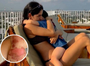 MAJA JE SINA ODVELA KOD LEKARA MISLEĆI DA IMA OPEKOTINE OD SUNCA: Kada je saznala koji SOK izaziva ovo - ostala je nepomična