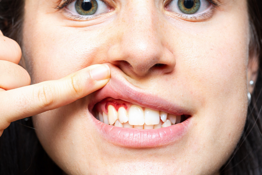 KAKVE VEZE IMA KRVARENJE DESNI SA DEMENCIJOM? Lekari otkrivaju da ovaj problem može da olakša jedan slatkiš