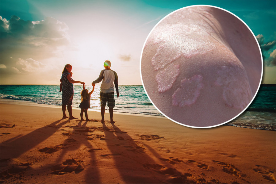 ČUVAJTE SE "SVRABA PLIVAČA" I HEPATITISA, OVO SU NAJOPASNIJE BOLESTI SA PLAŽE! Infekcije vrebaju sa svih strana