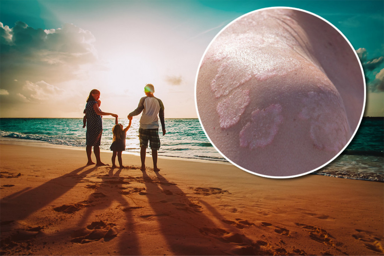 ČUVAJTE SE "SVRABA PLIVAČA" I HEPATITISA, OVO SU NAJOPASNIJE BOLESTI SA PLAŽE! Infekcije vrebaju sa svih strana