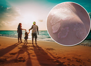 ČUVAJTE SE "SVRABA PLIVAČA" I HEPATITISA, OVO SU NAJOPASNIJE BOLESTI SA PLAŽE! Infekcije vrebaju sa svih strana