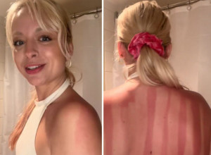 IMA OPEKOTINE NA LEĐIMA KAO TRAKE: Nanela zaštitnu kremu, ali u jednom je pogrešila, a rezultat je zastrašujuć!