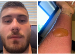 MARKO SE IZ IZLASKA VRATIO SA PLIKOM NA RUCI: Ležao sam 20 dana u bolnici, mislili su da će slediti amputacija! (VIDEO)