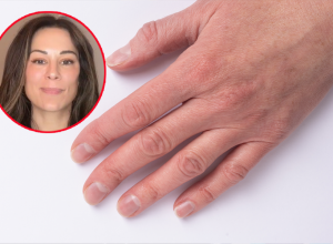 JEDNA PROMENA NA NOKTIMA MOŽE DA UKAŽE NA RAK! Dermatolog upozorava: "Veća je šansa da će biti benigna ako je svetlija"