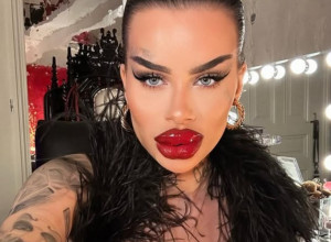 ZAVISNICA OD BOTOKSA POTROŠILA GARSONJERU U BEOGRADU NA OPERACIJE: Sada je otkrila nešto još šokantnije, a onda pokazala nova usta! (FOTO)