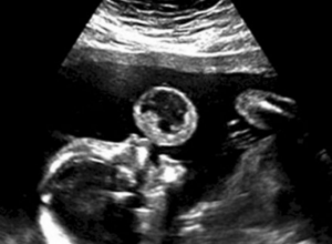 MISLILI SU DA NA ULTRAZVUKU VIDE BEBU KAKO DUVA BALON: Kada je stigla dijagnoza sledili su se - odmah su predložili abortus, ali majka nije htela ni da čuje! (VIDEO)