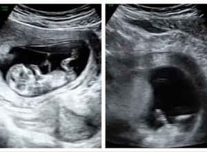 TRUDNICA SE TOKOM ULTRAZVUKA NASMEJALA: Usledio je ŠOK prizor, doktorka nije znala kako da je smiri! (VIDEO)