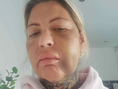 Zbog podliva i otoka ju je sramota da izlazi na ulicu 