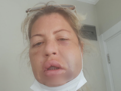 Viki je otekla i imala je konstantne infekcije 