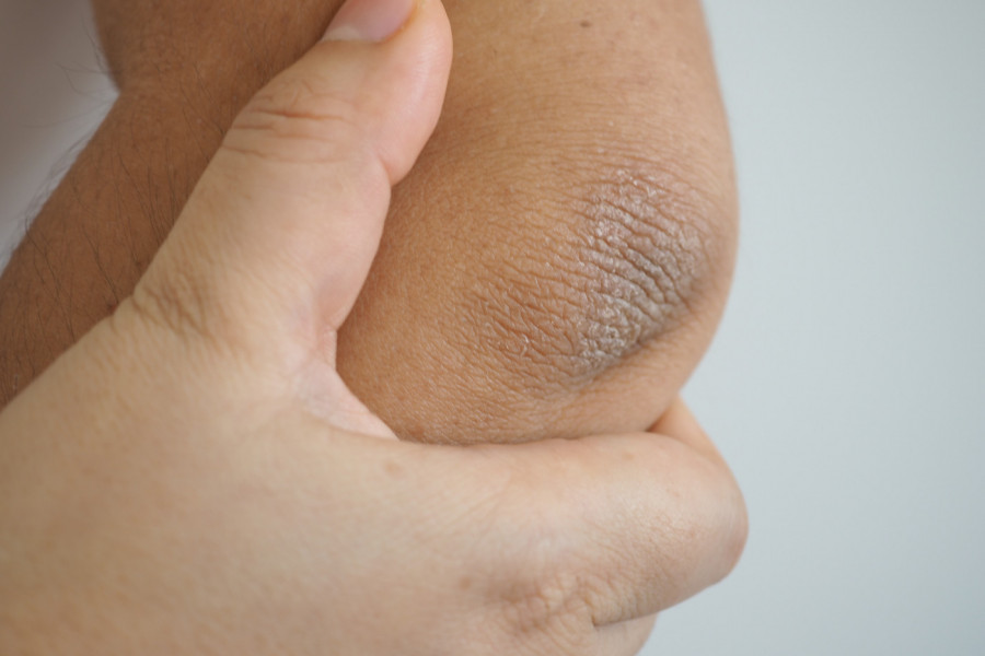 DOBRO SE ZAGLEDAJTE - ova promena na laktu ukazuje na zapaljensko oboljenje: Ako imate i ovaj simptom, pregled je OBAVEZAN