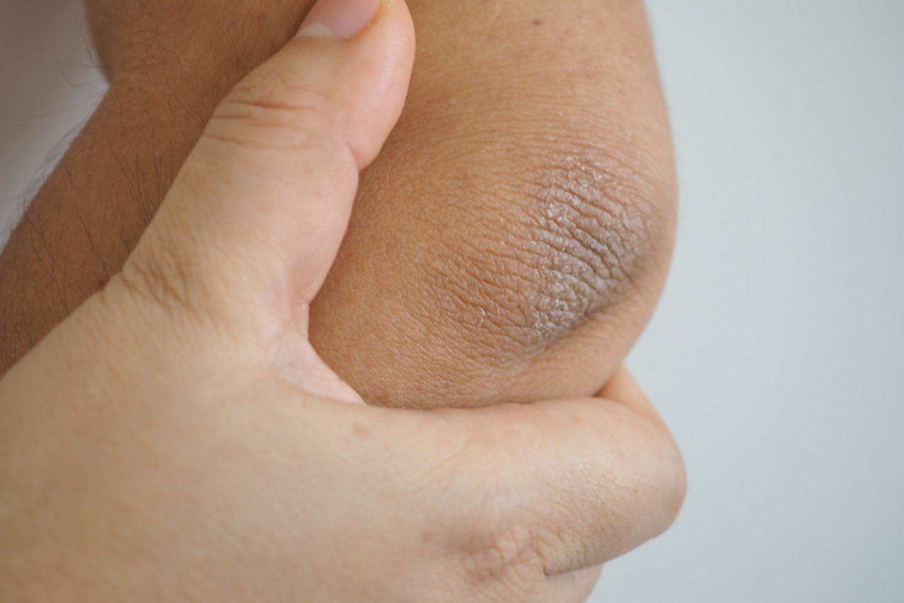 DOBRO SE ZAGLEDAJTE - ova promena na laktu ukazuje na zapaljensko oboljenje: Ako imate i ovaj simptom, pregled je OBAVEZAN