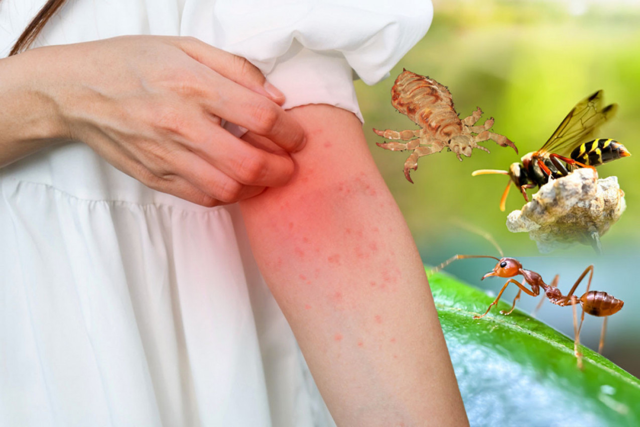 OVO MOŽE DA VAM SPASE ŽIVOT - KAKO DA PREPOZNATE KOJI VAS JE INSEKT UJEO! Ovi detalji su najvažniji, jer svaki sekund je bitan!