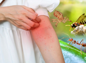 OVO MOŽE DA VAM SPASE ŽIVOT - KAKO DA PREPOZNATE KOJI VAS JE INSEKT UJEO! Ovi detalji su najvažniji, jer svaki sekund je bitan!