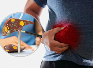 OVAJ SIMPTOM MASNE JETRE VIDI SE I BEZ PREGLEDA: Opasno je ignorisati ga - iznenadni znak vidi se na GLAVI!