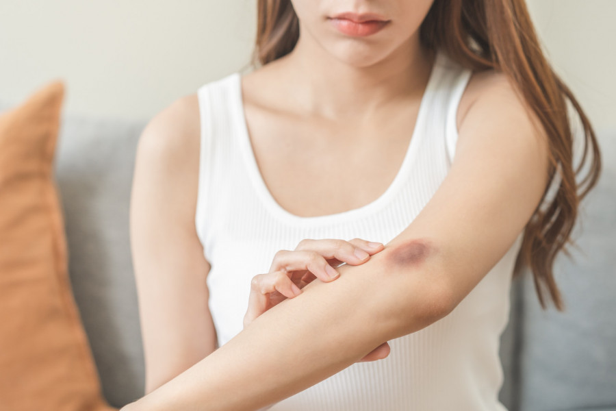 PET PRIRODNIH NAČINA DA UBLAŽITE MODRICE: Jedno piće, na koje ne biste ni pomislili, provereno pomaže i ubrzava oporavak!