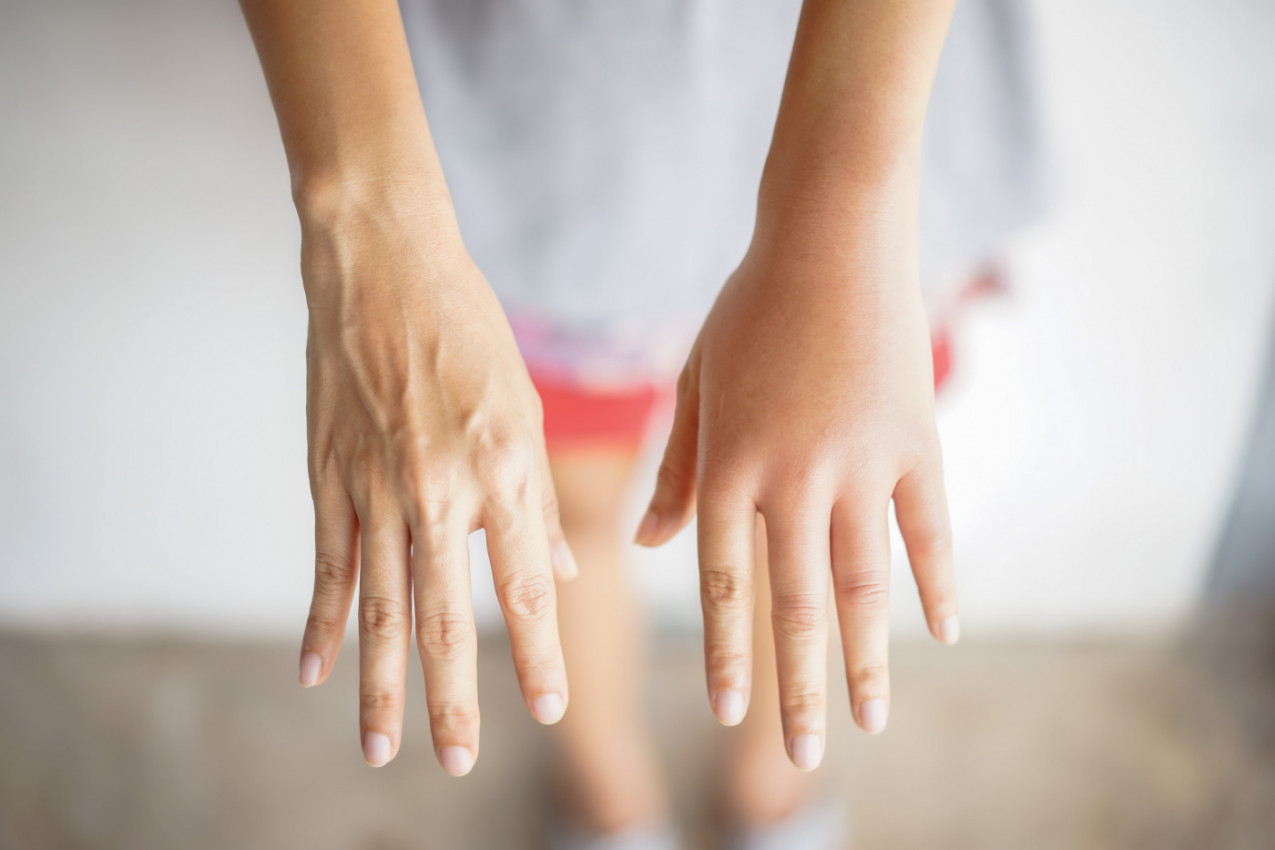 DOBRO POGLEDAJTE SVOJE RUKE, AKO OVO PRIMETITE NA PRSTIMA, TO MOŽE DA BUDE ZNAK SKRIVENE BOLESTI PLUĆA: Na ove detalje morate da obratite pažnju