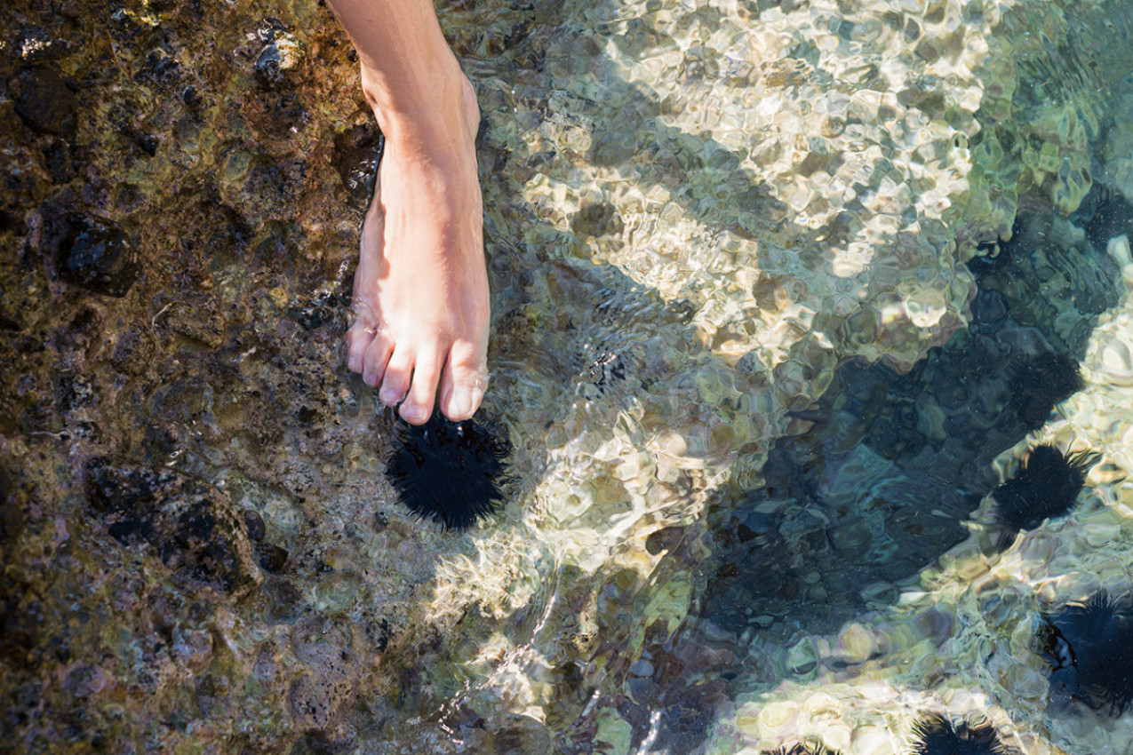 NAGAZILI STE NA MORSKOJ JEŽA NA PLAŽI, EVO ŠTA TREBA DA URADITE: Ova namirnica iz kuhinje pomaže da izvadite bodlje bez muke!