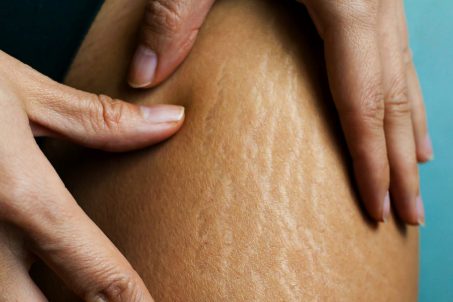 STRIJE MOGU ZAUVEK OSTAVITI TRAG NA VAŠOJ KOŽI: Evo kako da ih zaustavite na vreme