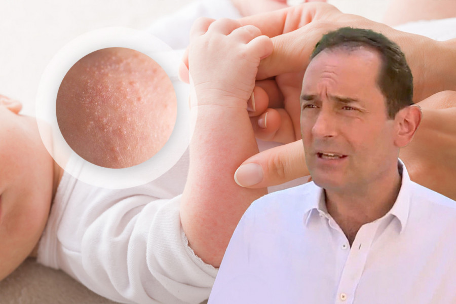 DA LI JE OSIP OD VRUĆINE KOD BEBA RAZLOG ZA UZBUNU i kako da ga razlikujete od boginja i alergije: Pedijatar otkriva ključni znak da preti opasni toplotni udar