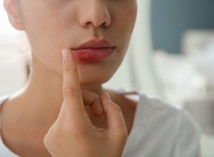 Kako brzo da ublažite herpes: Prirodni trikovi koji pomažu već kod prvih simptoma