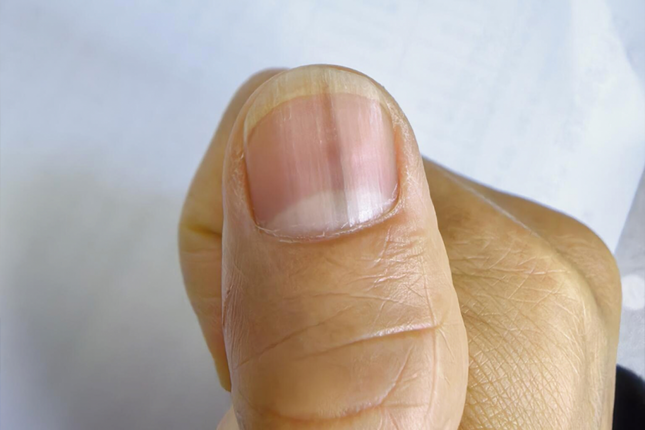 Ako imate TAMNU LINIJU ispod nokta, odmah se obratite lekaru