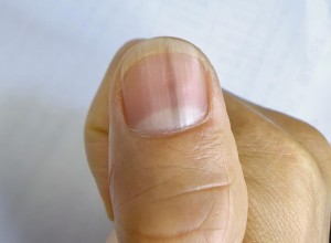 Ako imate TAMNU LINIJU ispod nokta, odmah se obratite lekaru