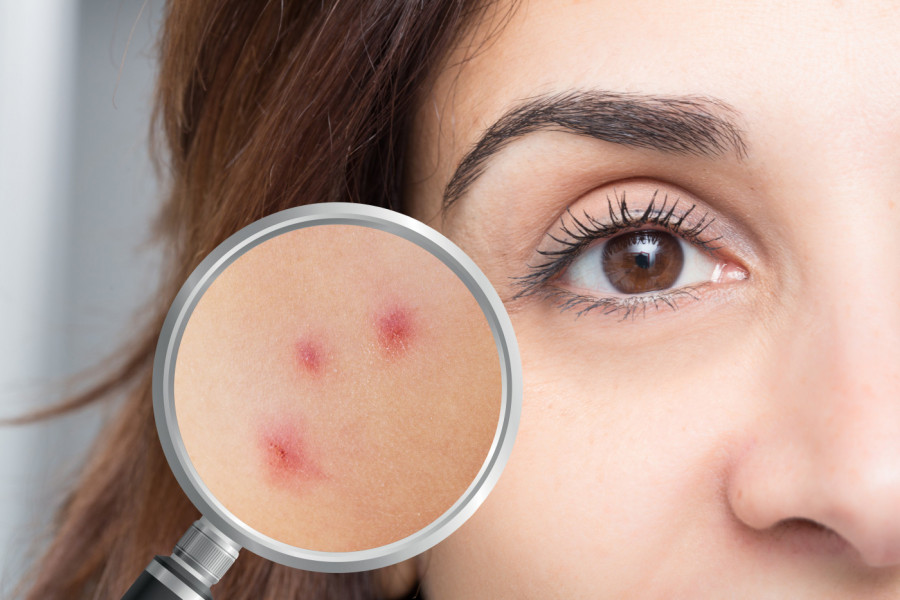 Šta zaista pomaže kod potkožnih bubuljica - evo kako da ih pravilno tretirate