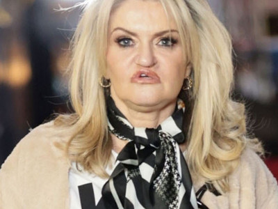 Sada je uradila kompletan lifting lica, vrata i obrva, kao i dodatne korekcije usana i nosa