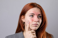Lice vam se iznenada ZACRVENI? Ovo je 15 najčešćih uzroka i trikovi kako da ga smirite kod kuće