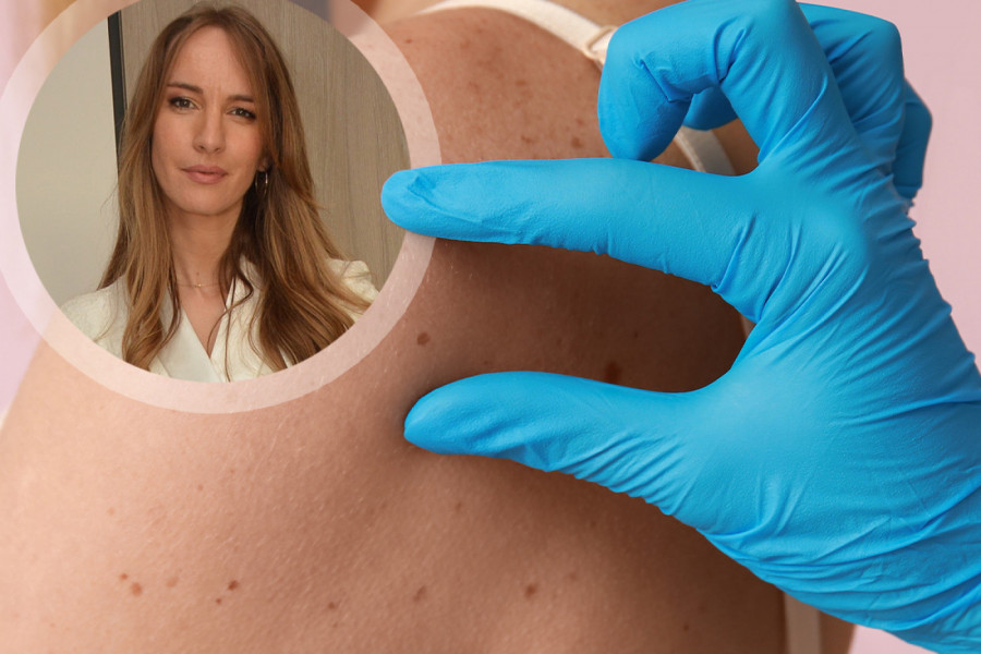 Dr Bojana Novović, dermatovenerolog: Jedna promena na MLADEŽU može biti opasna – proverite da li ste u riziku!