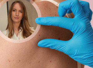 Dr Bojana Novović, dermatovenerolog: Jedna promena na MLADEŽU može biti opasna – proverite da li ste u riziku!