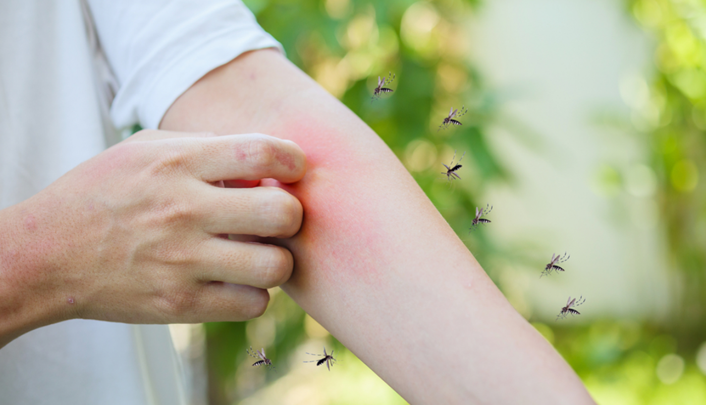 Svrbi vas ujed komarca? Godinama radimo jednu veliku grešku – evo šta zaista pomaže, a šta samo pogoršava problem