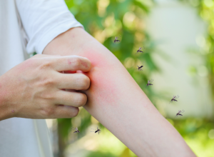 Svrbi vas ujed komarca? Godinama radimo jednu veliku grešku – evo šta zaista pomaže, a šta samo pogoršava problem